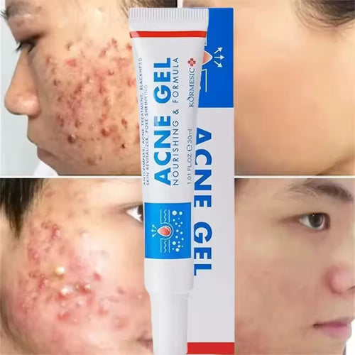 Acne Gel