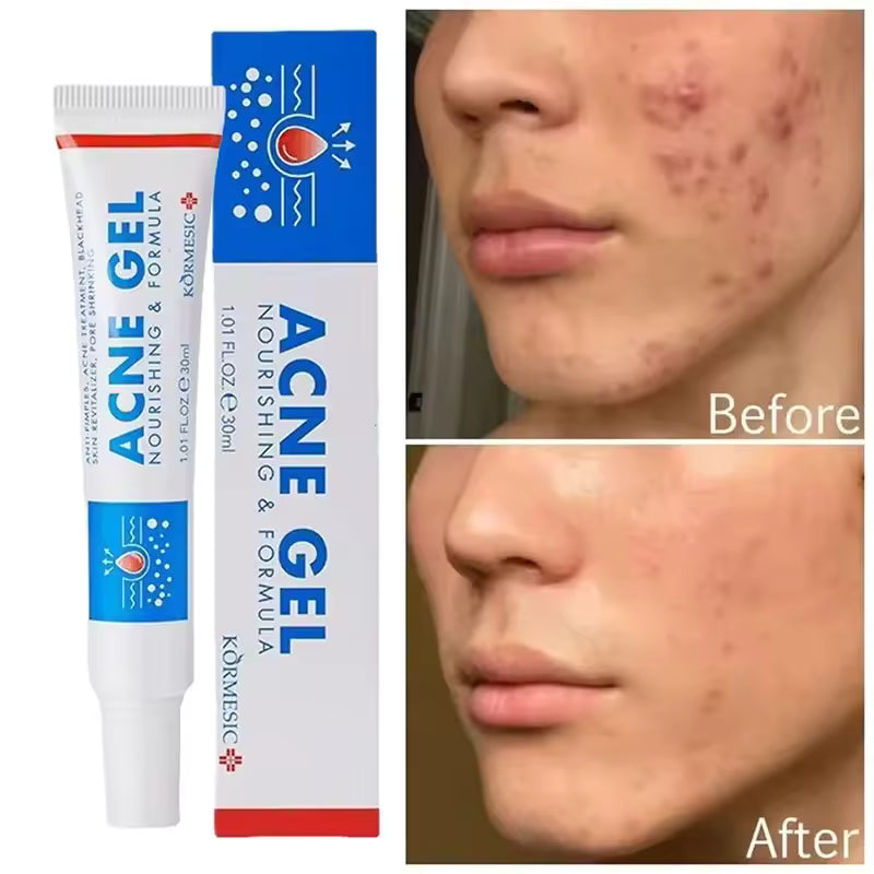 Acne Gel