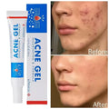 Acne Gel